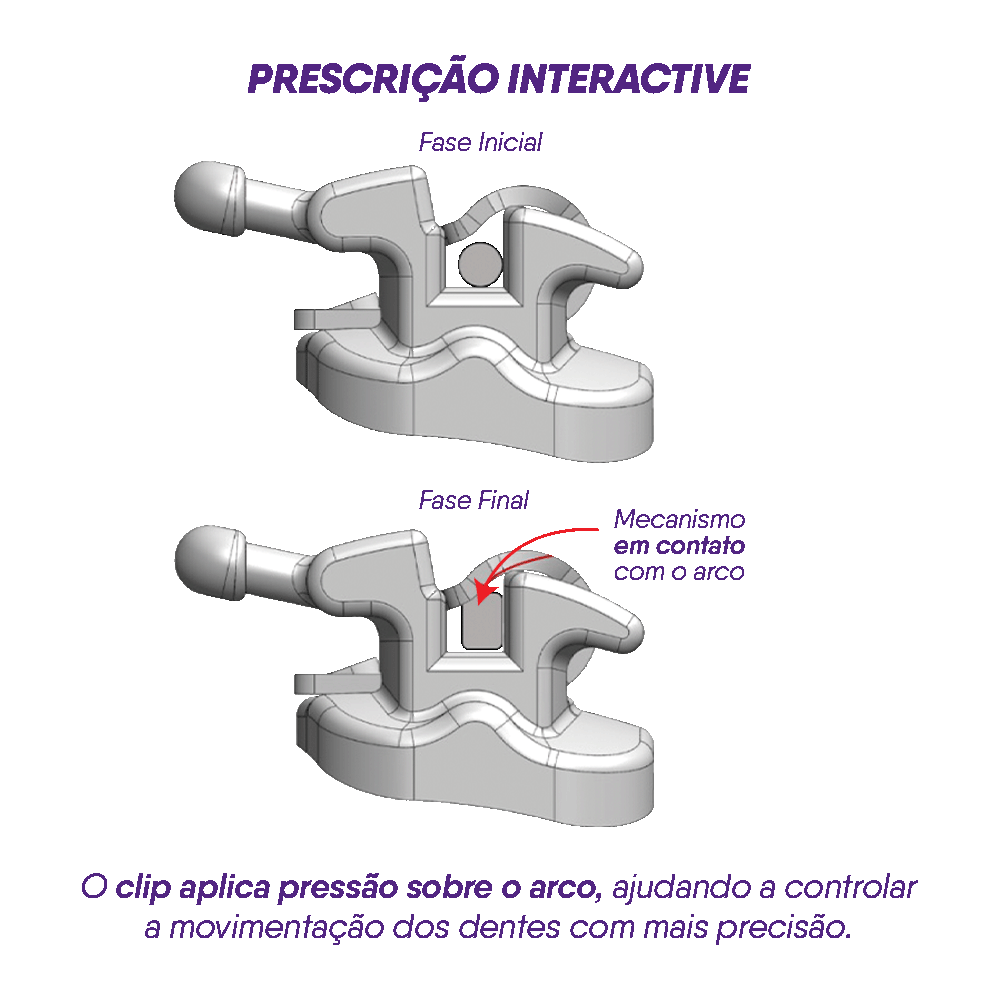 11.45.2200 – Bráquete Auto ligado de Aço Interativo U-Clip MBT 0,022 – 01 caso